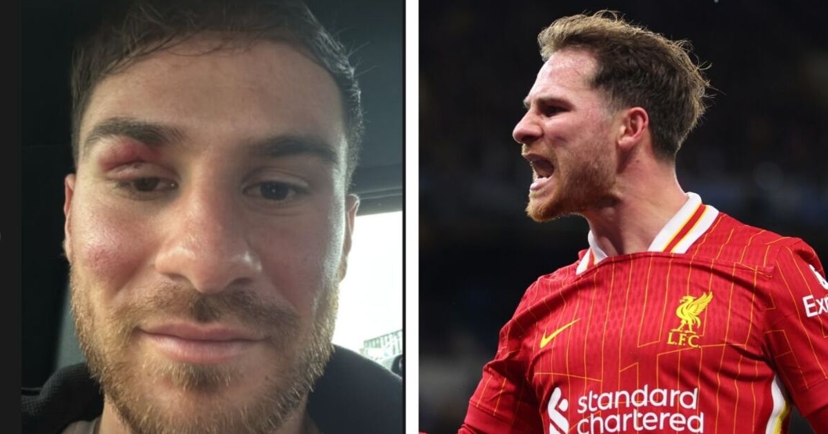 Liverpool ace shows off gruesome black eye a day after Man City battle